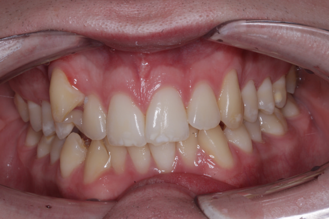 invisalign behandling før